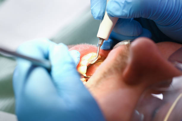 Best Emergency Root Canal Treatment in Wabash, IN